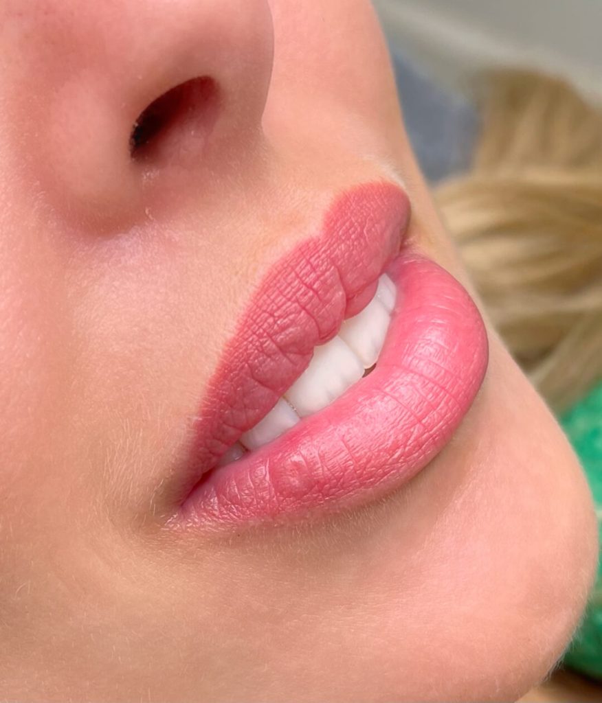 Lip filler after 3 months