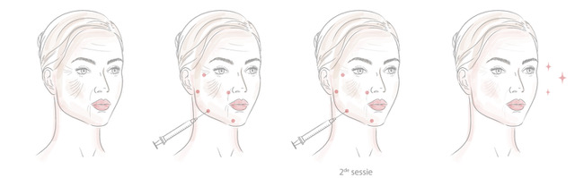 injectables step by step