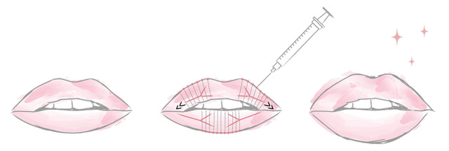 étapes du remplissage des lèvres