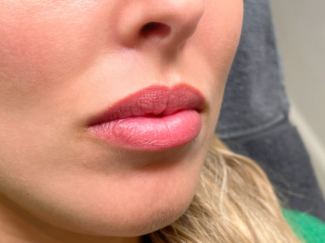 lip filler result after 3 months