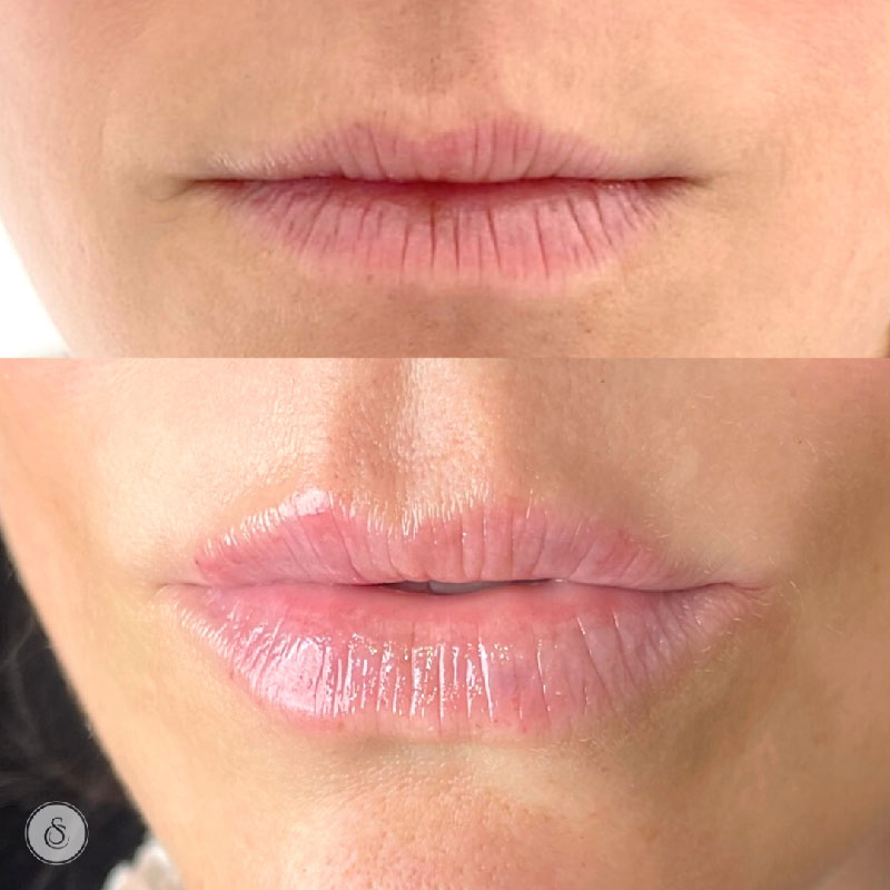 Hydratation des lèvres de la Clinique Sarasin avant et après