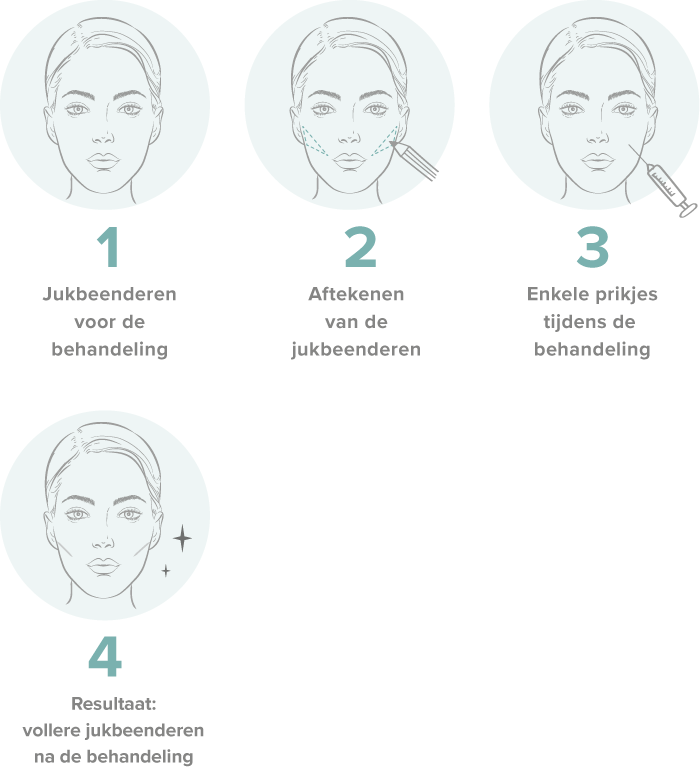 jukbeenfiller behandeling ingevallen wandeling procedure