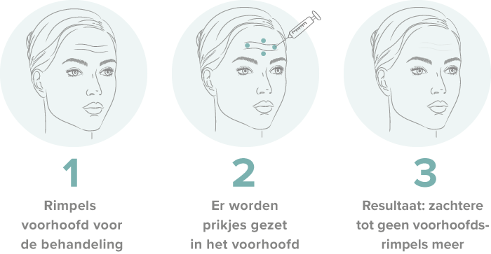 behandelingprocedure filler voorhoofd