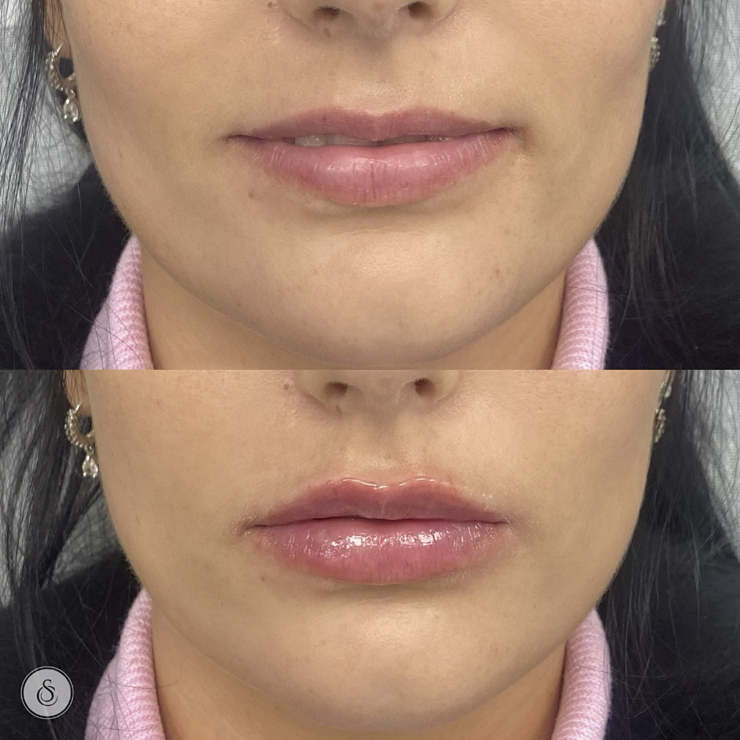 lipfiller lip balancing